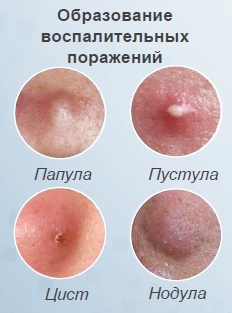 aktivy-syvorotki-anti-acne-smorodina-v-tsifrakh_03.jpg