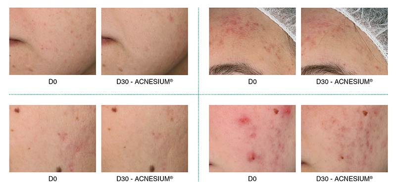 aktivy-syvorotki-anti-acne-smorodina-v-tsifrakh_01.jpg aktivy-syvorotki-anti-acne-smorodina-v-tsifrakh_01.jpg